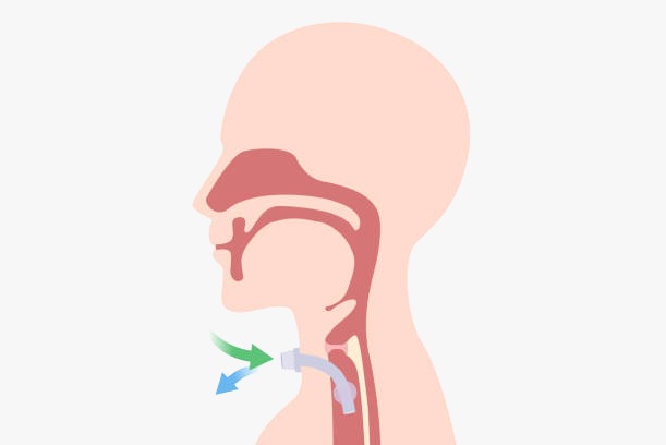 Tracheostomy Care Service